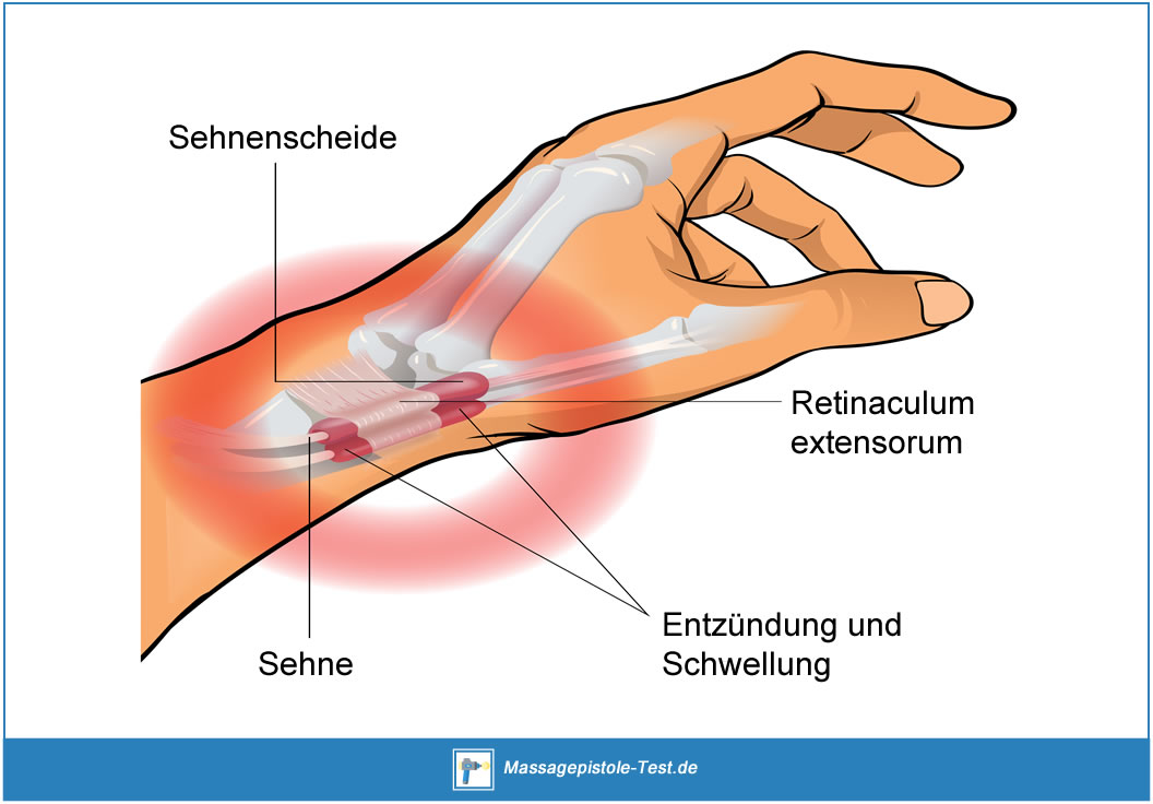 Wie äußert Sich Eine Sehnenscheidenentzündung